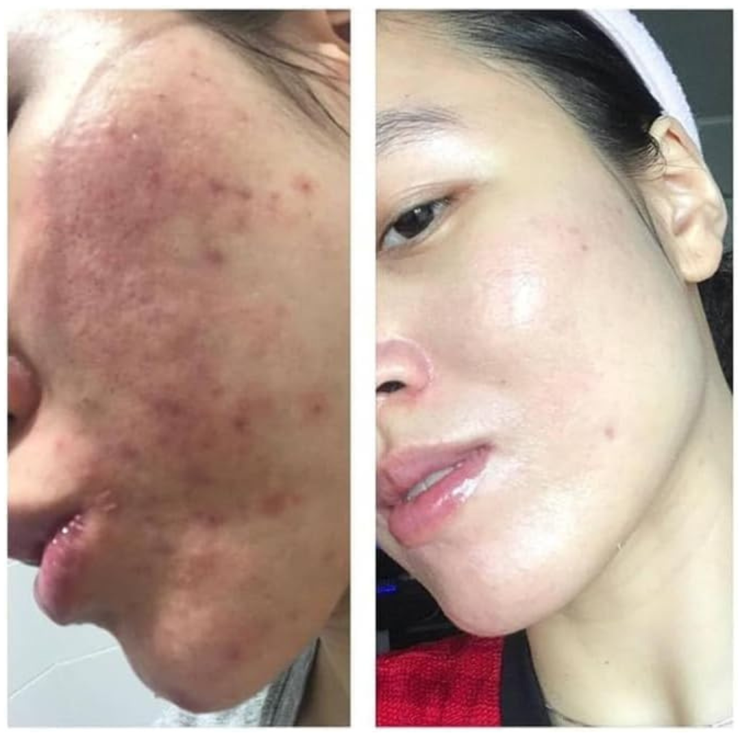 سكينورين كريم 20% حمض الأزيليك skinoren 20% cream – azelaic acid سكينورين كريم 20% حمض الأزيليك skinoren 20% cream – azelaic acid